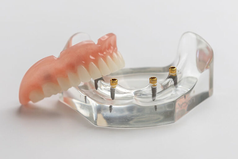 Implant Stabilized Overdentures